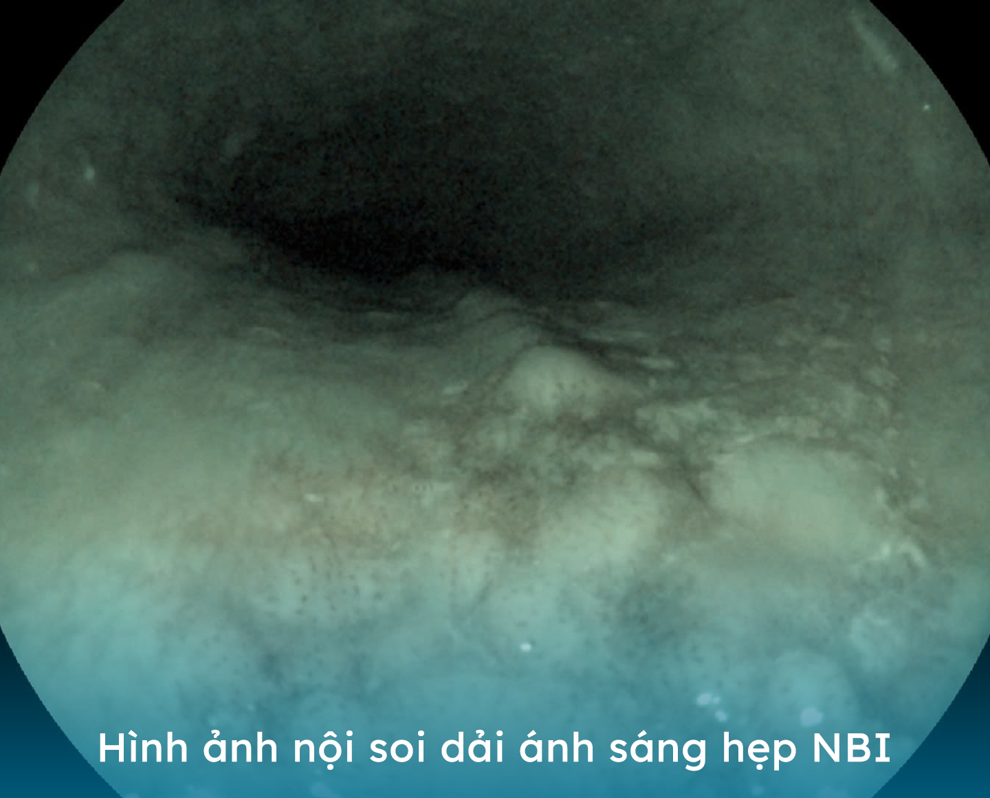 Bệnh viện Hoàn Mỹ Vinh: phát hiện nhiều trường hợp tiền ung thư thông qua nội soi- Ảnh 2.