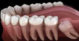 Những biến chứng thường gặp khi mọc răng khôn không thể xem nhẹ