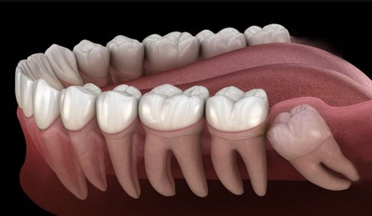 Những biến chứng thường gặp khi mọc răng khôn không thể xem nhẹ- Ảnh 2.