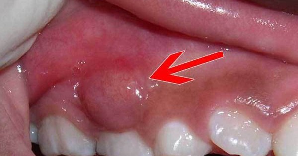 Cảnh báo biến chứng nguy hiểm của áp xe răng