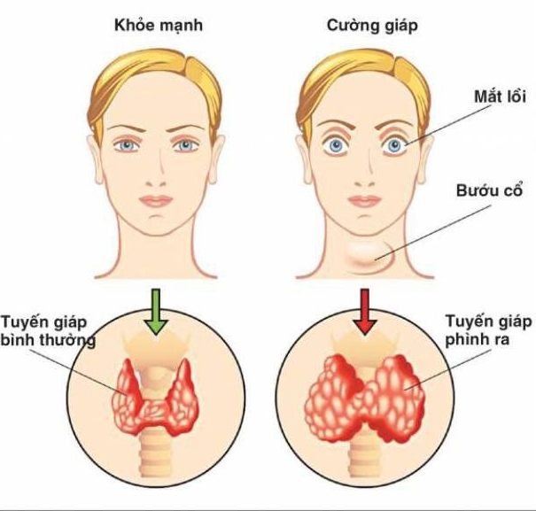 Những bệnh tuyến giáp ngày càng phổ biến trong cộng đồng- Ảnh 2.