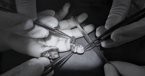 Bé 5 tuổi đứt rời 2 ngón tay khi chơi xe điện tự chế