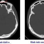 Bệnh viện Việt Nam – Thụy Điển Uông Bí phẫu thuật thành công ca u xương sọ hiếm gặp