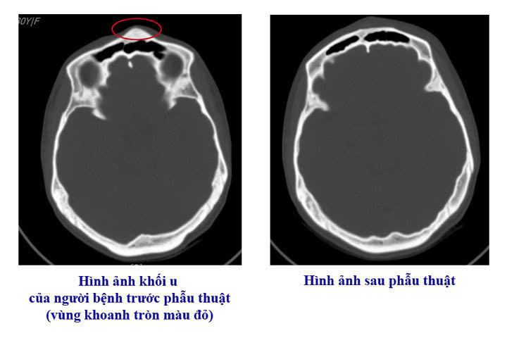 Bệnh viện Việt Nam - Thụy Điển Uông Bí phẫu thuật thành công ca u xương sọ hiếm gặp- Ảnh 1. Bệnh viện Việt Nam - Thụy Điển Uông Bí phẫu thuật thành công ca u xương sọ hiếm gặp- Ảnh 1.