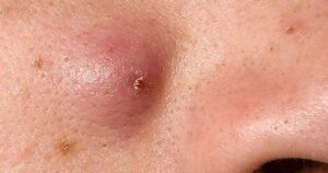 Cách chữa mụn nhọt hiệu quả