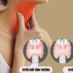 Những bệnh tuyến giáp ngày càng phổ biến trong cộng đồng