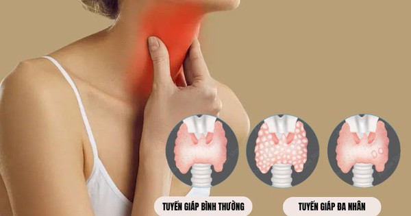 Những bệnh tuyến giáp ngày càng phổ biến trong cộng đồng