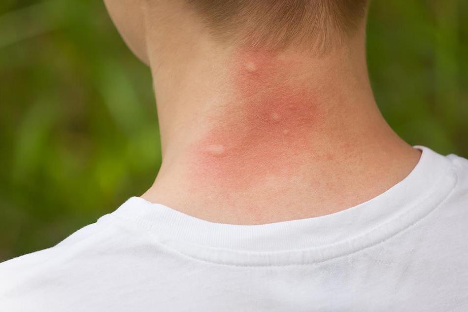 Nhận biết vết côn trùng cắn, đốt và cách xử trí đúng để tránh biến chứng nguy hiểm- Ảnh 2.