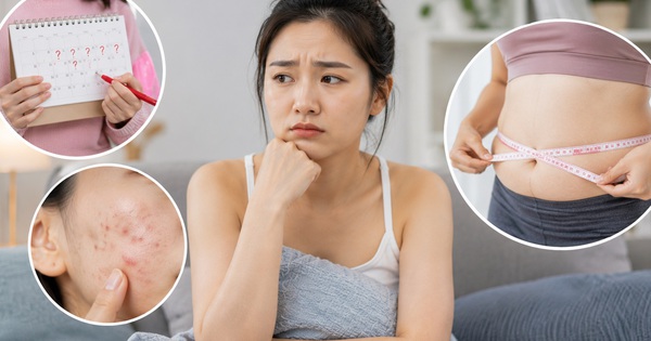 Dấu hiệu buồng trứng đa nang dễ bị bỏ qua