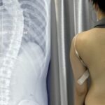 Vẹo cột sống ở trẻ gây hệ lụy gì?