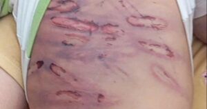 Sức khỏe của bé trai 2 tuổi bị mẹ ruột và cha dượng bạo hành giờ ra sao?