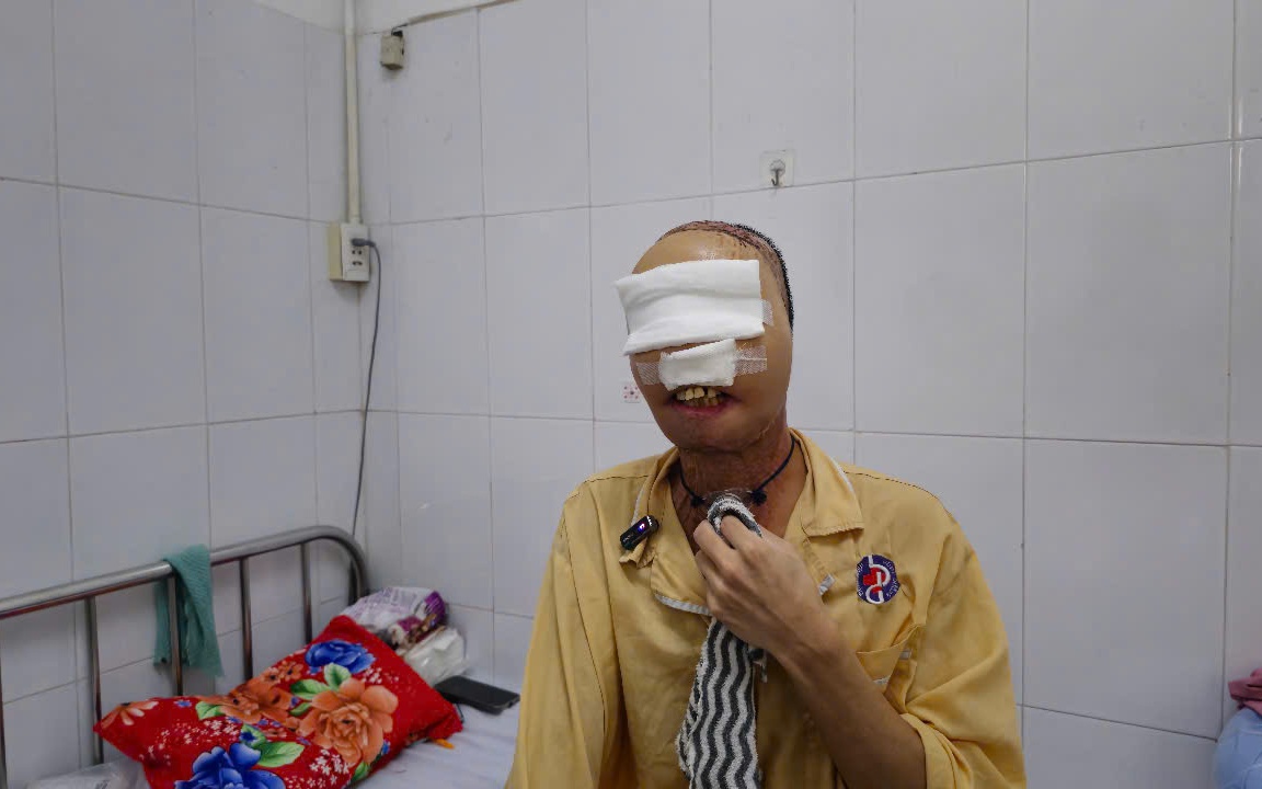 Hành trình "làm lại gương mặt" cho chàng thanh niên mang di chứng bỏng suốt 3 năm