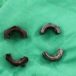 Dị vật kim loại ‘khóa chặt’ dương vật, bệnh nhân suýt phải trả giá đắt