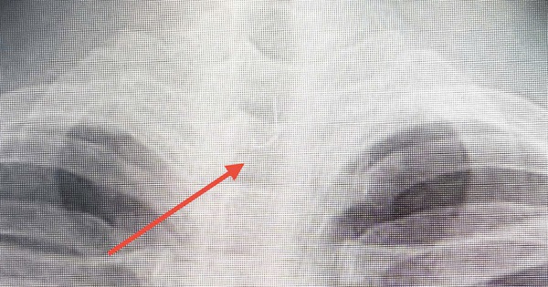 Sau ăn cá người đàn ông 46 tuổi bị mắc lưỡi câu sâu trong thực quản