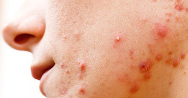 Mụn trứng cá bọc có nên nặn không?