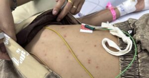 TPHCM: Cứu sống bé 7 tuổi mắc não mô cầu nhóm B diễn tiến nhanh