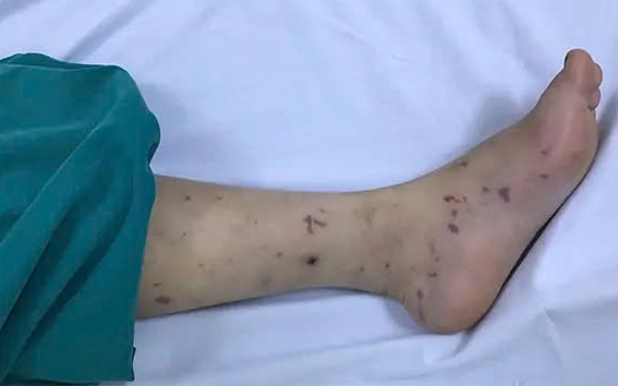 Bé 2 tuổi tử vong do não mô cầu thể tối cấp tại TPHCM