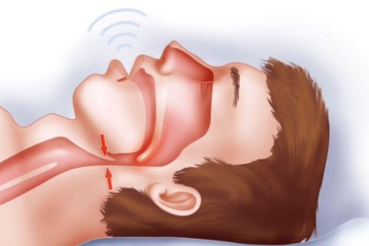 ‎OSAS là một sự suy yếu của giấc ngủ và rối loạn hô hấp được định nghĩa như sự ngừng thở 10 giây, ít nhất 5 lần trong 1 giờ ngủ.