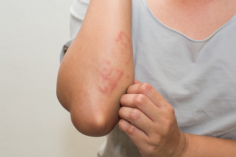 Da nổi mẩn đỏ, ngứa: dấu hiệu dị ứng hay cảnh báo bệnh lý tiềm ẩn?- Ảnh 2.