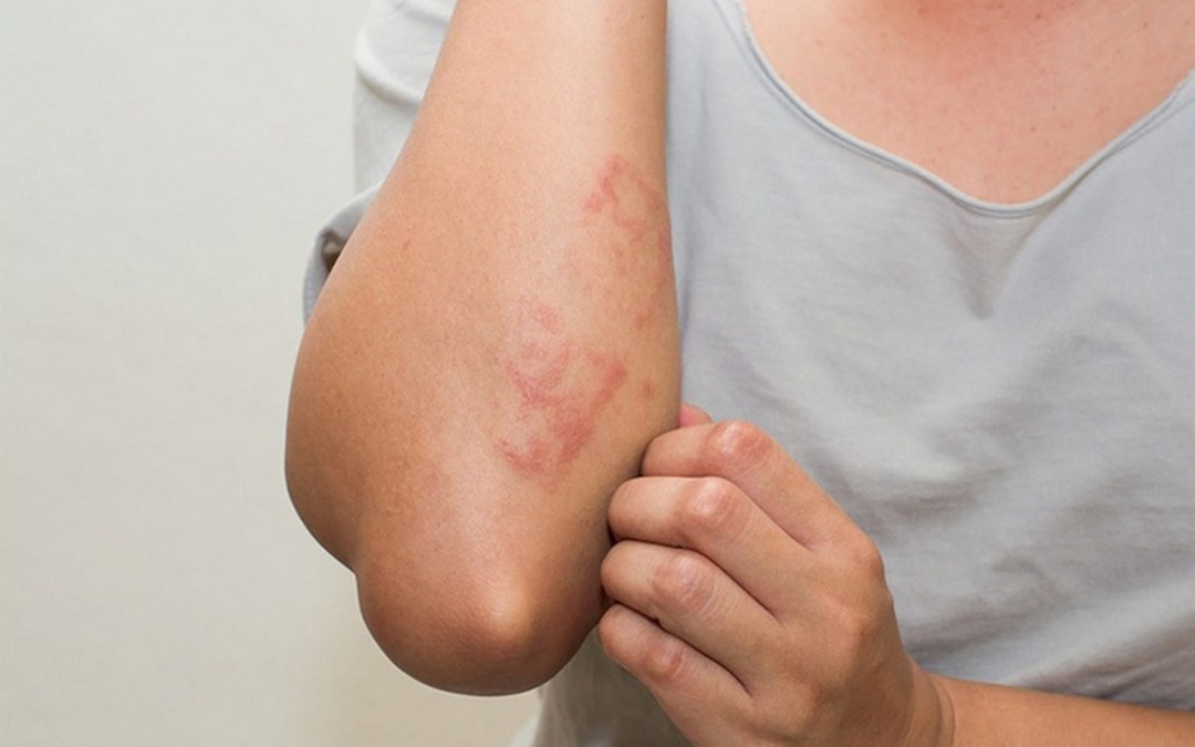 Mẩn đỏ, ngứa khắp người là biểu hiện của bệnh gì?