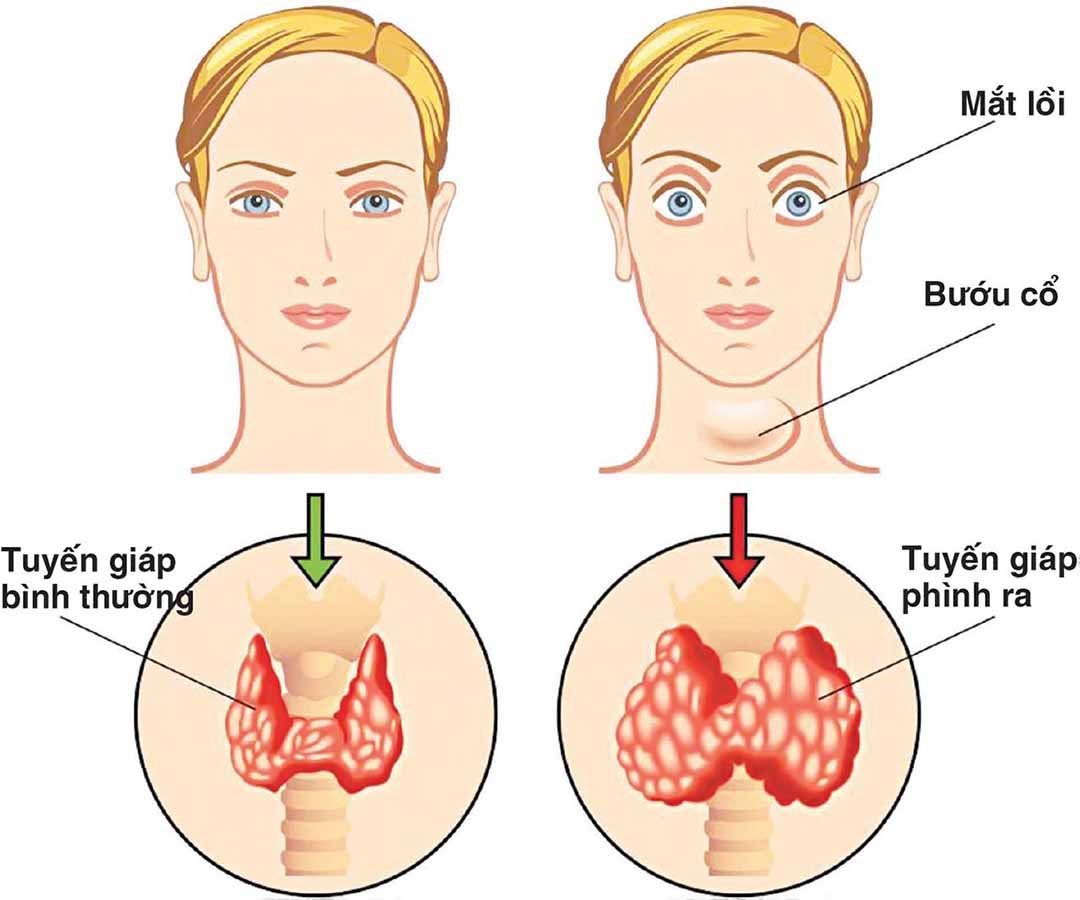 Dùng muối hạt thay muối iod: Thói quen tưởng lành mạnh nhưng chưa chắc phù hợp- Ảnh 2.