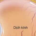 Ruồi bay trước mắt có thể là dấu hiệu xuất huyết dịch kính nguy hiểm