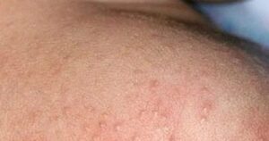 Mùa hè nhiều rôm sảy cần xử trí ra sao?