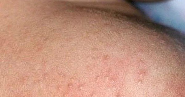 Mùa hè nhiều rôm sảy cần xử trí ra sao?