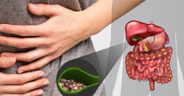 Bệnh sỏi túi mật phổ biến nhưng thường bị xem nhẹ, cảnh báo biến chứng nặng