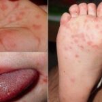 Khánh Hòa đã ghi nhận 2.254 ca tay chân miệng, bác sĩ khuyến cáo điều cần nhớ để phòng bệnh