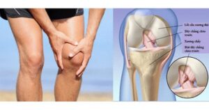Đau khớp gối khi leo cầu thang có đáng lo?