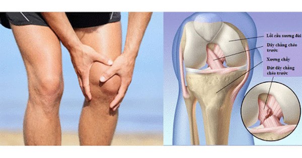 Đau khớp gối khi leo cầu thang có đáng lo?