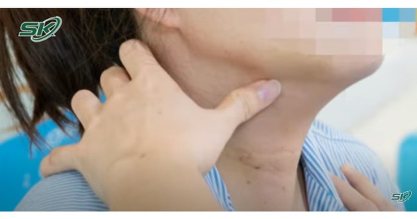 Viêm tuyến giáp mạn tính có làm tăng nguy cơ ung thư tuyến giáp không ?