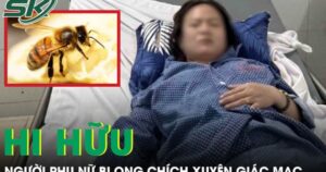 Ong chích xuyên giác mạc, người phụ nữ sưng phù mắt phải cấp cứu khẩn