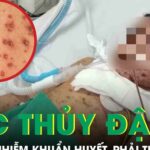 Biến chứng thủy đậu, bé trai 6 tuổi nhiễm khuẩn huyết, phải thở máy nguy kịch