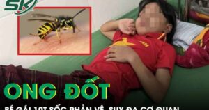 Ong vò vẽ đốt 70 vết, bé gái 10 tuổi sốc phản vệ, suy đa cơ quan phải cấp cứu gấp
