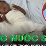 Bé 22 tháng tuổi bỏng nước sôi cấp cứu trong nguy kịch