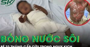 Bé 22 tháng tuổi bỏng nước sôi cấp cứu trong nguy kịch