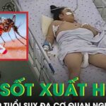 Sốc sốt xuất huyết, bệnh nhi 10 tuổi suy đa cơ quan, tổn thương gan cấp tính nguy kịch