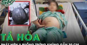 Tá hoả phát hiện khối u buồng trứng ‘cực khủng’ gần 30cm từ dấu hiệu đau bụng