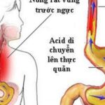 5 nguy cơ khi dùng nhiều thuốc giảm tiết acid ở người trào ngược dạ dày – thực quản