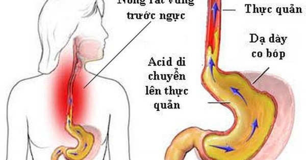 5 nguy cơ khi dùng nhiều thuốc giảm tiết acid ở người trào ngược dạ dày – thực quản
