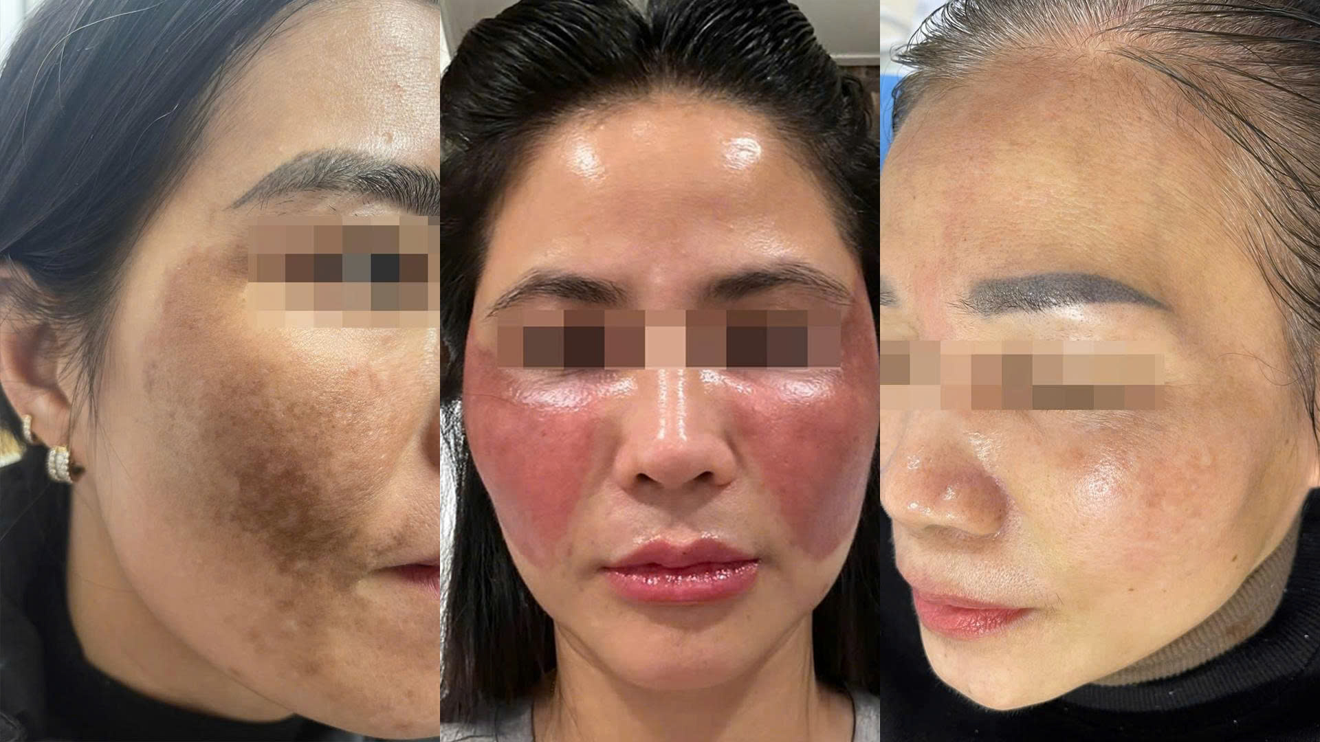 BSCKII Nguyễn Tiến Thành – người đồng hành với những làn da biến chứng nặng- Ảnh 1.