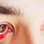 Nguyên nhân gây cộm mắt và cách khắc phục