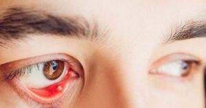 Nguyên nhân gây cộm mắt và cách khắc phục