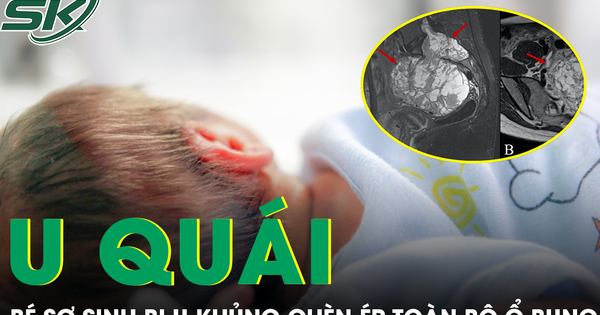 Cứu trẻ sơ sinh 10 ngày tuổi mang khối u hiếm gặp, chèn ép toàn bộ ổ bụng