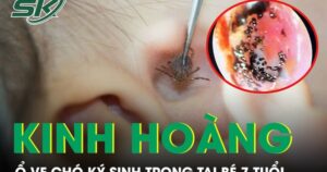 Kinh hoàng phát hiện ổ ve chó ký sinh trong tai bé trai 7 tuổi