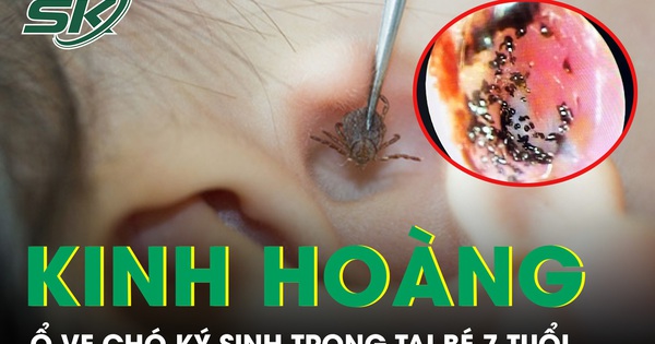 Kinh hoàng phát hiện ổ ve chó ký sinh trong tai bé trai 7 tuổi