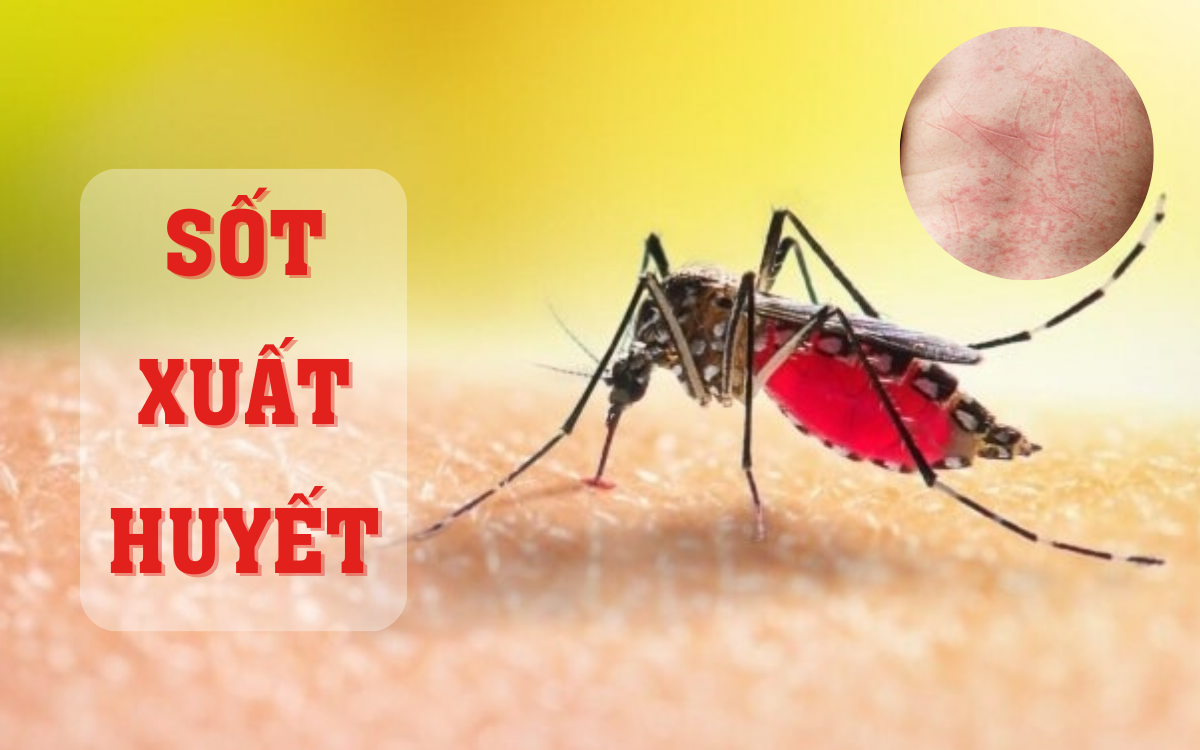 Mùa hè cảnh giác với sốt virus ở trẻ em- Ảnh 2.