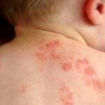 Bệnh chốc mùa hè: Nhận biết sớm để tránh biến chứng